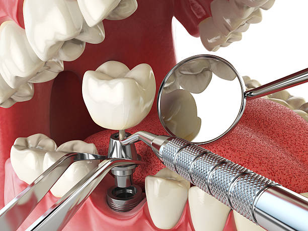 Best Broken or Cracked Tooth Emergency Dentist in Woodlawn, VA